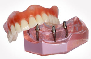 all-on-4 dental implant denture
