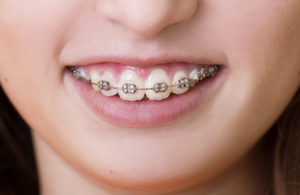 orthodontics and braces
